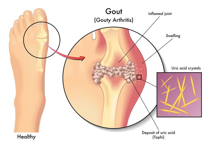 diagram of gout in foot with uric acid crystals